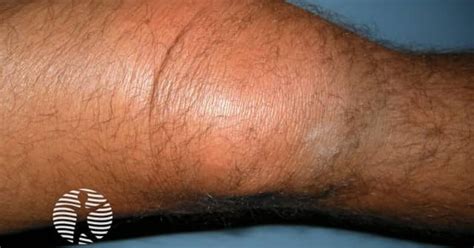 bee sting reaction image