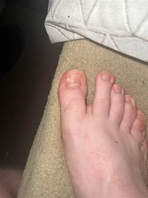 After surgery it went fine, i no longer experience pain in my toe