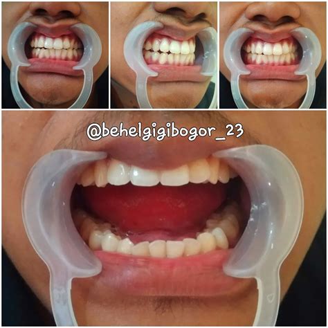 lovely behel nteeth atbehelgigibogor instagram