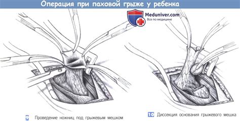 Этапы и техника операции при паховой грыже у ребенка