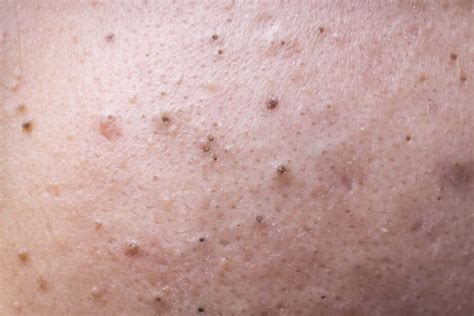 How To Get Rid Of Blackheads: The Best And Worst Ways - ALLURE OF BEAU