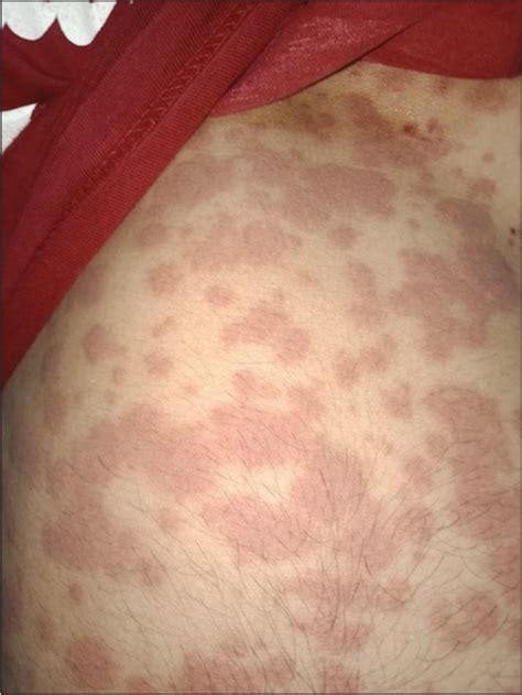 Std Skin Rash On Chest