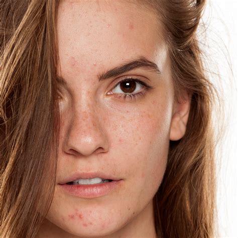 acne skin care kit national acne positivity day dp derm