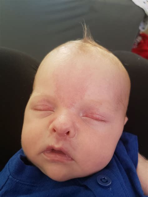 Stork Bite Eyelid