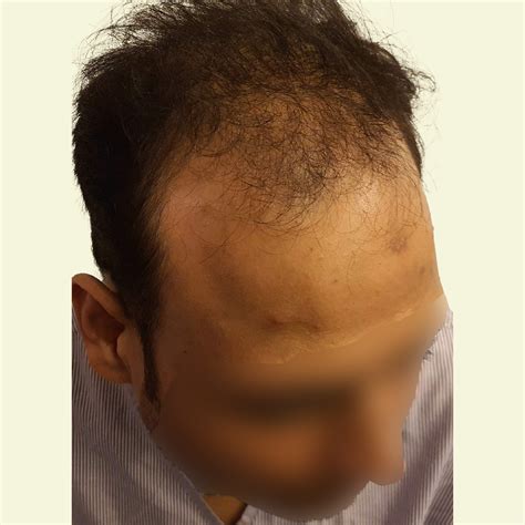 Patient 18 Before & After Surgery Results - Crown - The Hair Transplant ...