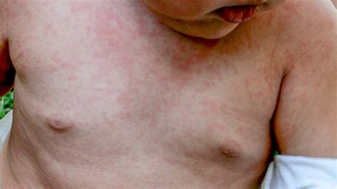 What Does A Viral Rash Look Like On Babies at Minh Boser blog