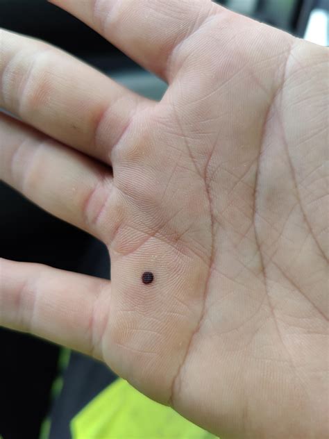 Internal Bleeding Hand