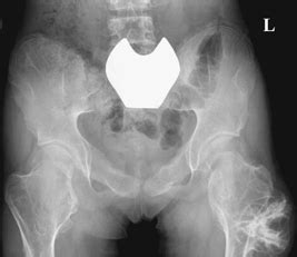 114 Multiple Hereditary Exostoses | Radiology Key