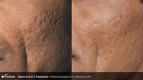 picosure-before-and-after-1 - Thin MD Med Spa