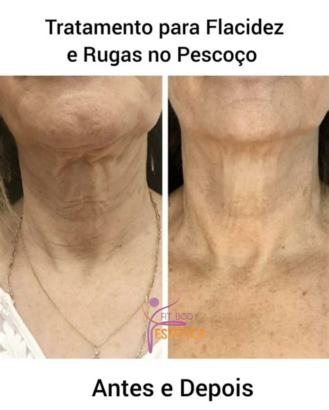Flacidez Pescoço Antes E Depois - Tratamento para Flacidez e Rugas no Pescoço Antes e Depois