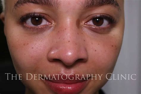 Freckle Tattoo - The Dermatography Clinic