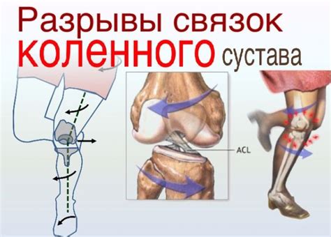 Лечение сухожилий коленного сустава: повреждение и разрыв связок и мышц