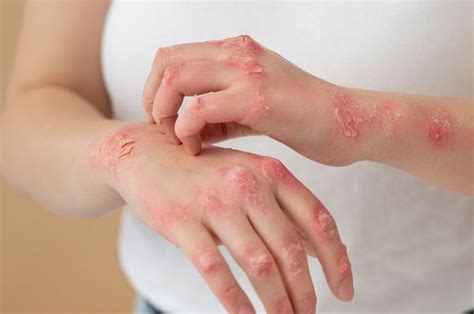 kenali tanda dermatitis atopik apakah gejalanya sama  alergi