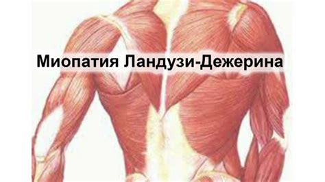 Миопатия Ландузи-Дежерина - YouTube