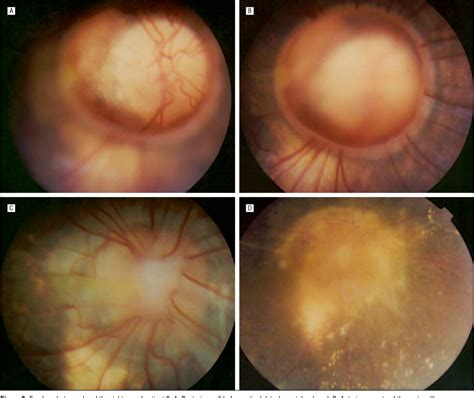 Peripapillary Staphyloma