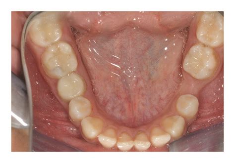 Intraoral view of left primary second molar extraction space (a).... | Download Scientific Diagram