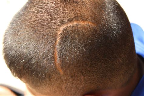 Receding Hairlines: Personalised Solutions for Men and Women
