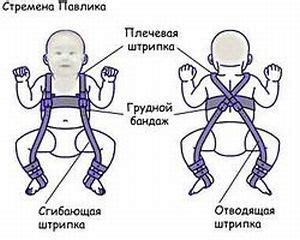 Как правильно одевать стремена павлика: отзывы, где купить