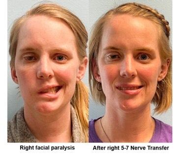 facial paralysis unc center  facial aesthetics