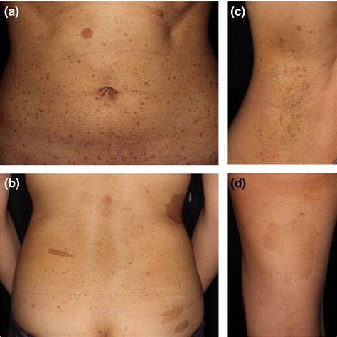 Legius Syndrome