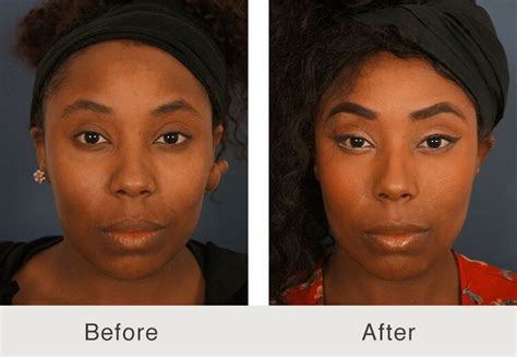 Keloid Removal - Carolina Facial Plastics