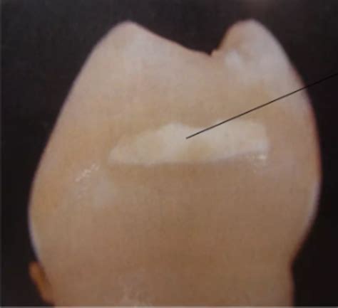 Week 14 - Histology of Caries & Developmental Disturbances Flashcards ...