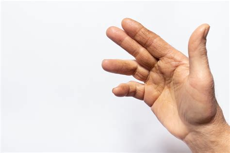 Dupuytren's Contracture Life Expectancy 2
