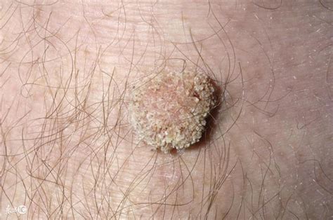 hpvhpv