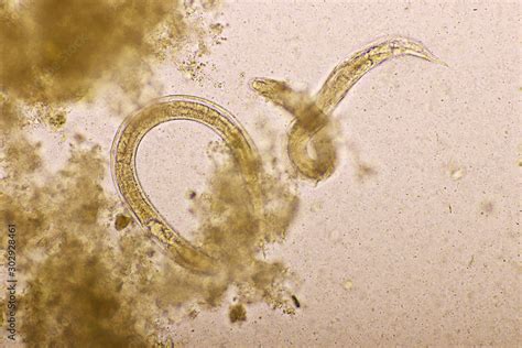 Strongyloides stercoralis or threadworm in human stool, analyze by ...