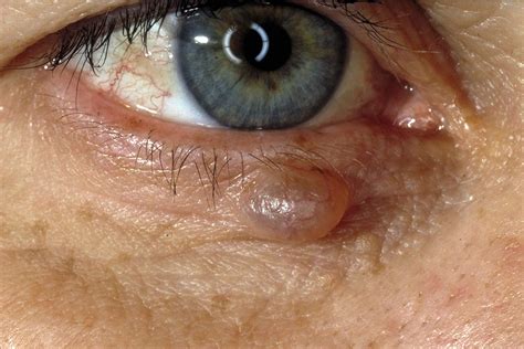 Can You Identify These 16 Types of Cysts?
