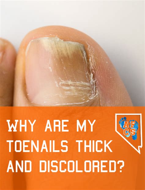 Thick, Discolored Toenails | Absolute Foot Care Specialists