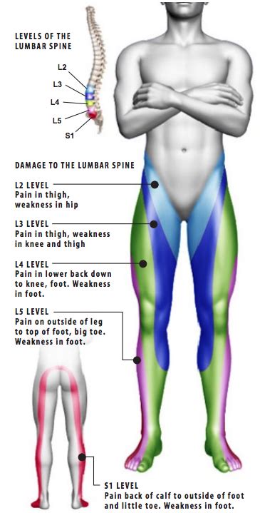 Sciatica (Lumbar Radiculopathy) - Shore Spine & Pain