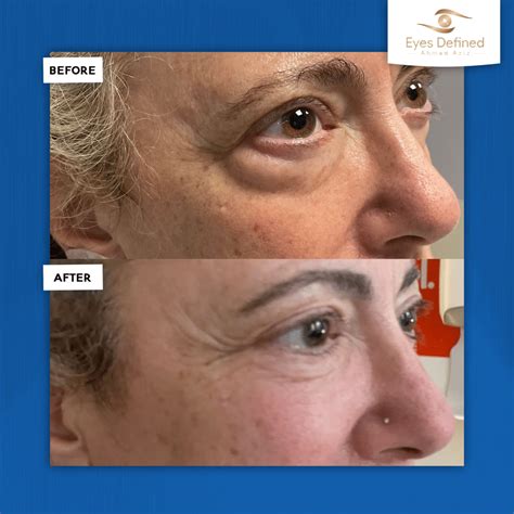 The Power of Blepharoplasty Before and After Photos