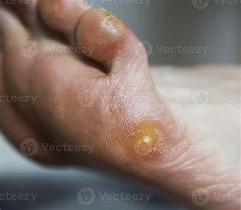 Plantar wart and callus on the patient's foot. Removal of warts and
