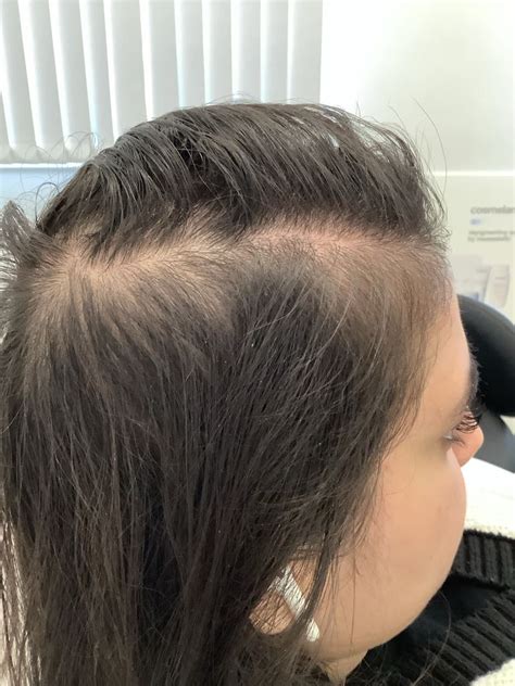 Hashia's Alopecia Before and After PRP & Exciplex Treatment - Este