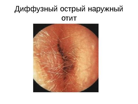 Диффузный наружный отит: симптомы и лечение у взрослых, фото