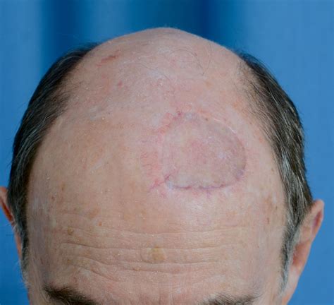 Stages Of Healing After Skin Graft at James Madrigal blog