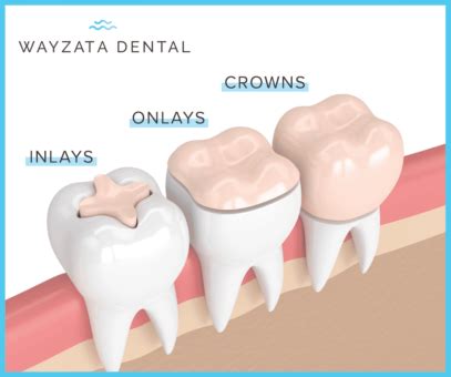 5 Best Alternatives to Dental Crowns in 2024