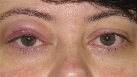 Drooping Eyelid | Eyelid Ptosis | Eye looking smaller | Mr David Cheung ...