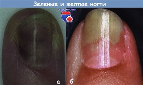 Причины зеленого пятна на ногте