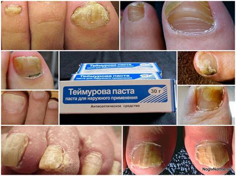 Паста Теймурова от грибка ногтей: инструкция, цена, отзывы