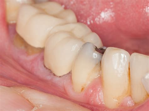 how to put a crown on tooth
