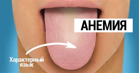 Дефицит железа