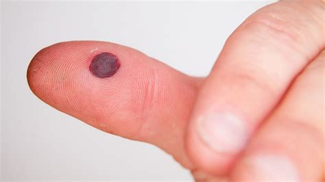 blisters  feet   treat  prevent