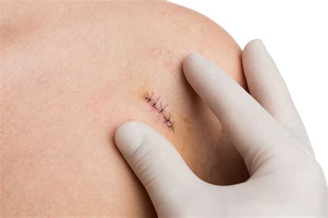 Caring for Your Skin Graft or Surgical Site After Mohs | Dermatology ...