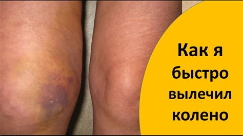 Как быстро вылечить ушиб колена - YouTube