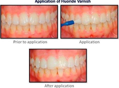 DENTAL FLUORIDE VARNISH - Manik Dental Clinic