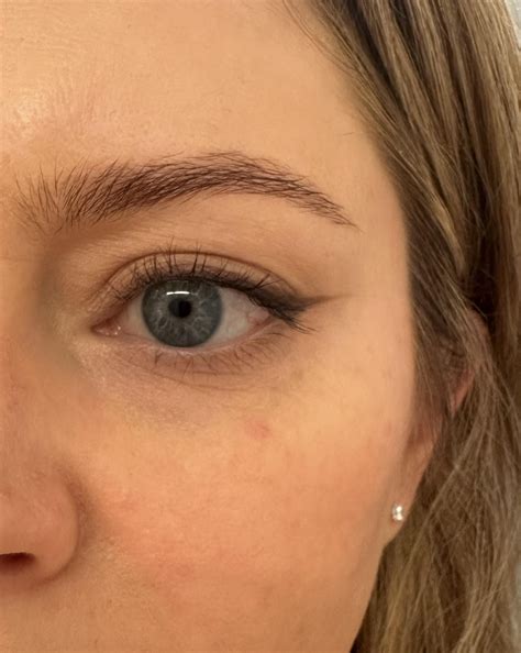 blood vessels in face burst 9