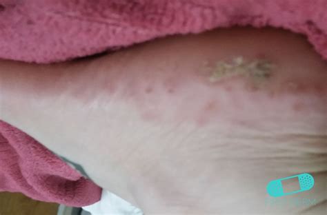 Online Dermatology - Dyshidrotic eczema (dyshidrosis)