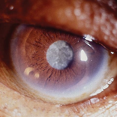 Cloudy Skies Ahead? Understanding and Overcoming Cataracts – Fillmore